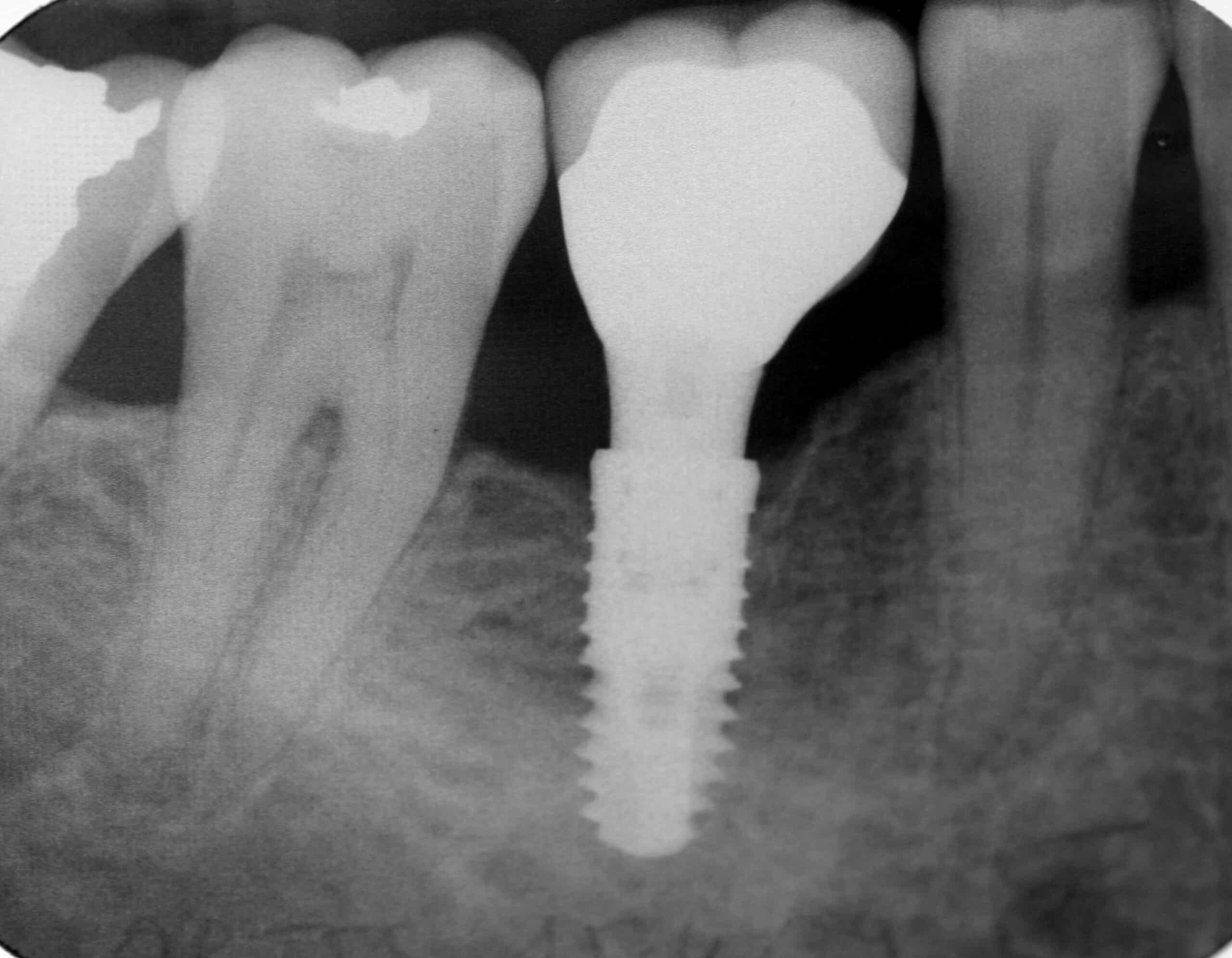 Couronne, bridge, implant : quelles différences entre les trois ?